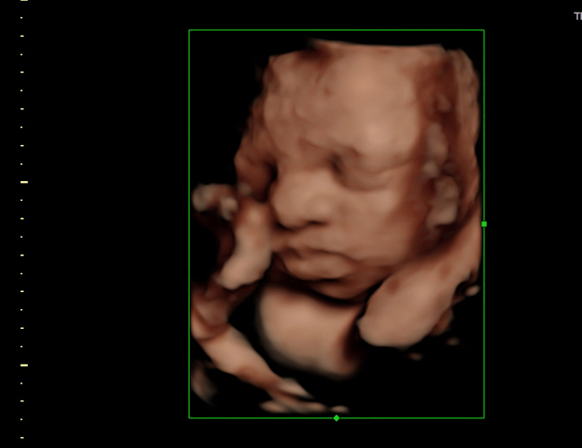 3D ultrasound image at 29 weeks
